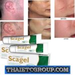 2 SCAGEL Scar gel reducer post surgery keloid stretch marks reduce fade burns