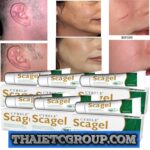 6 SCAGEL Scar gel reducer post surgery keloid stretch marks reduce fade burns